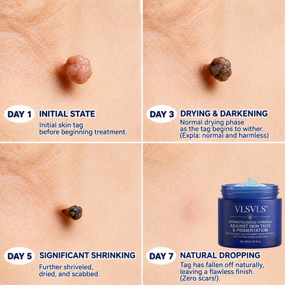 💡💡𝑽𝑳𝑺𝑽𝑳𝑺® 7-Day Skin Tag & Spot Eraser Cream (Pain-Free Formula – No Scarring) 🌱